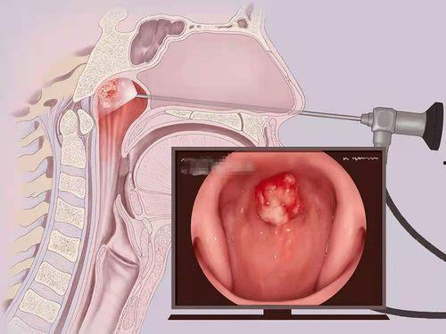 喉镜吃瓜,一场别开生面的“吃瓜”之旅